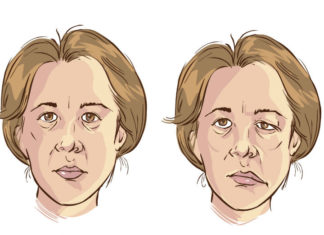 Parálisis Facial, qué Puede Ocasionarla